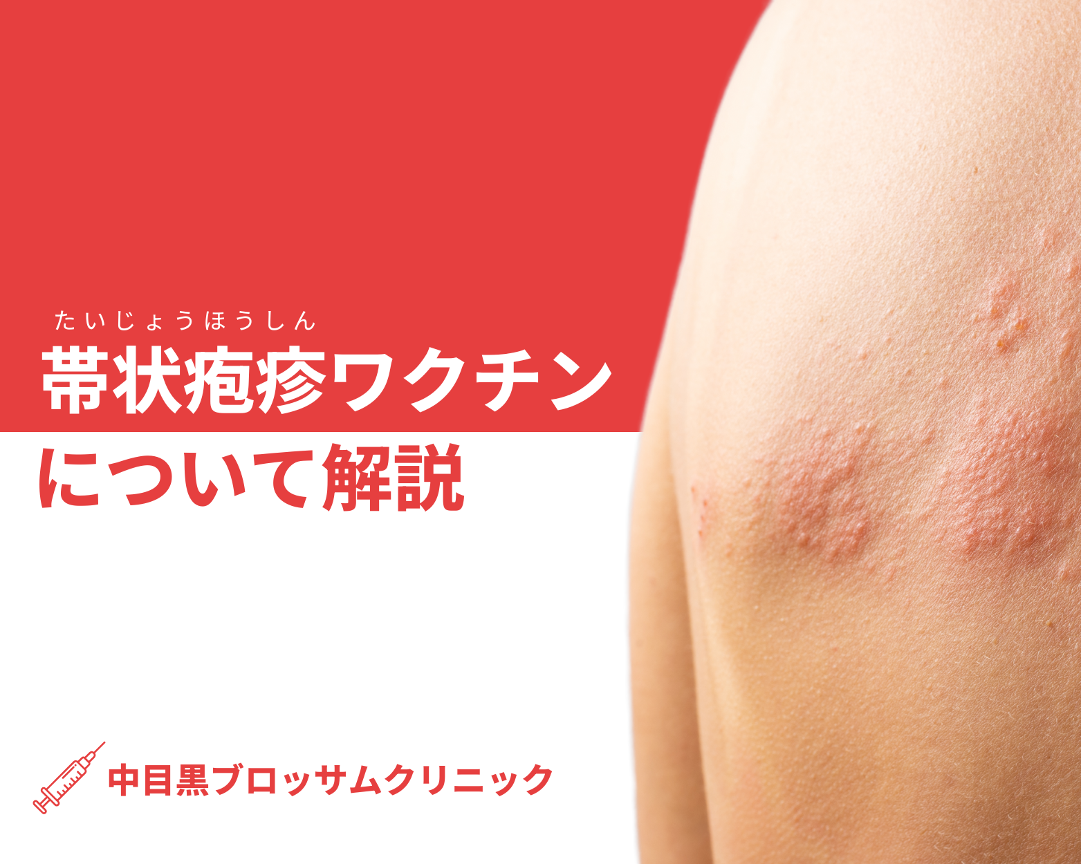 帯状疱疹ワクチンのイメージ画像
